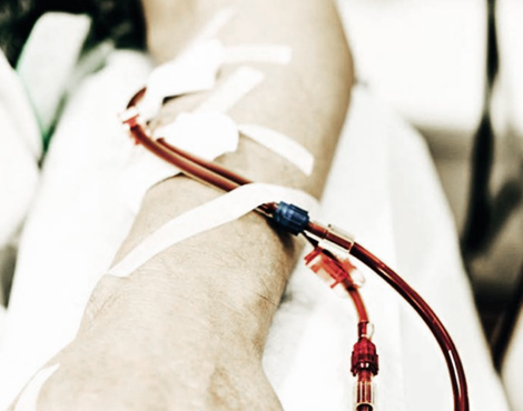 Armen på en patient, som får hæmodialyse på hospital